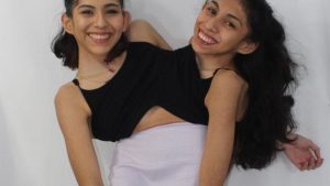 Conjoined Twin Carmen Andrade Shares Look Into Her Summer With Husband