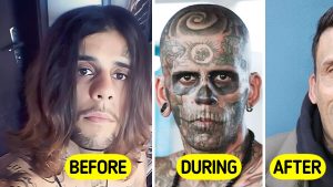 Man Who Was 95% Tattooed Shows Shocking Transformation After Laser Removal Surgery