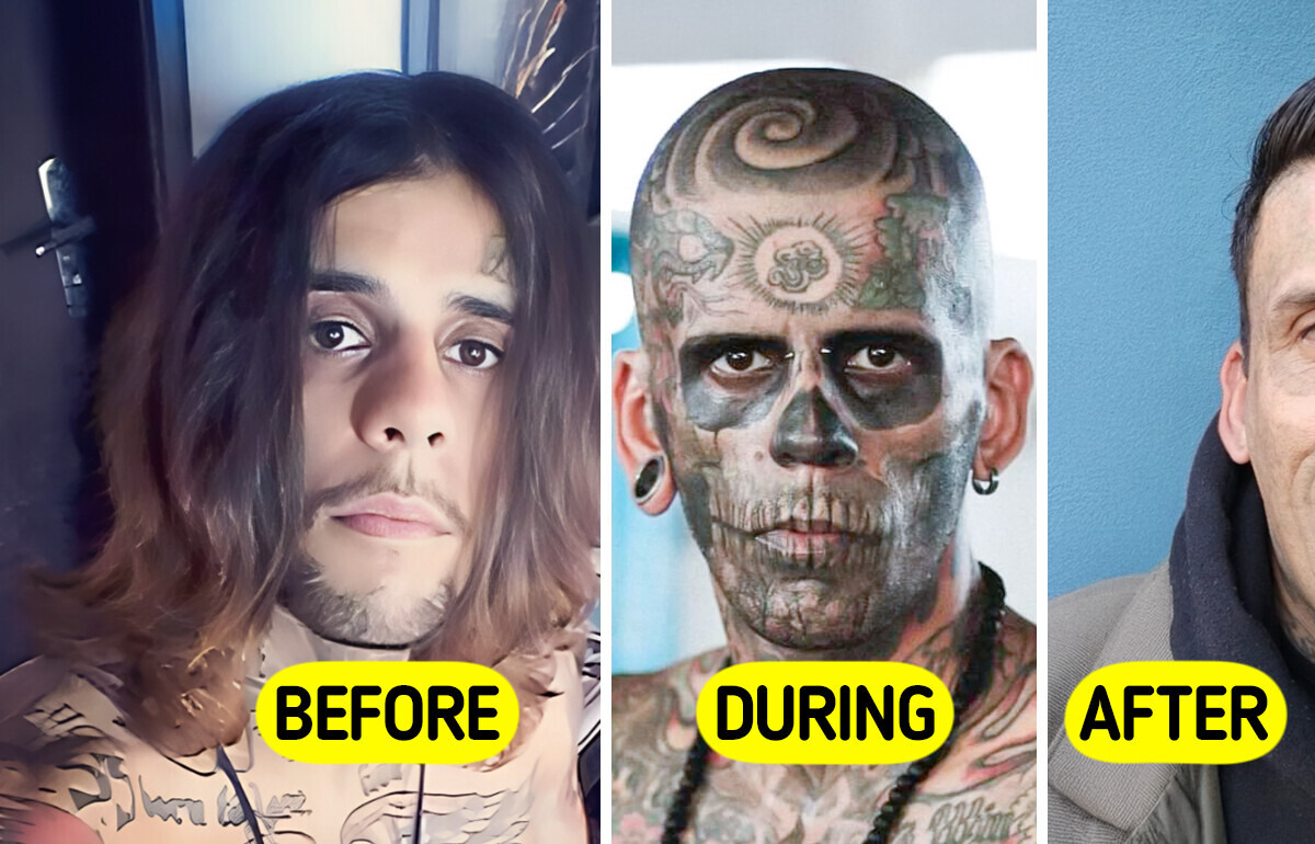 Man Who Was 95% Tattooed Shows Shocking Transformation After Laser Removal Surgery
