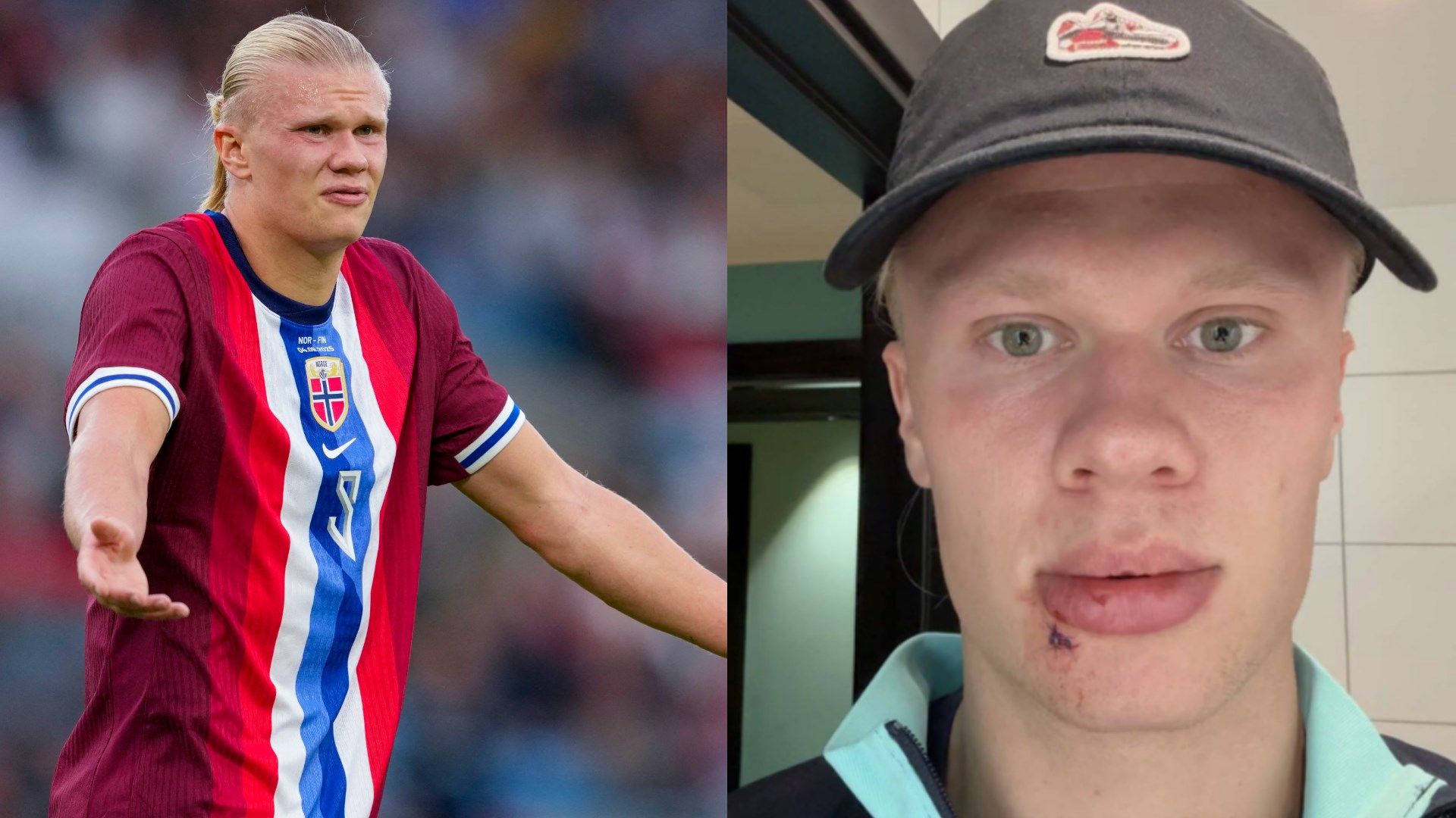 Freak injury leaves Erling Haaland requiring three stitches! Man City striker left bloodied on international duty with Norway
