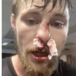 Uninsured Bryce Mitchell begs someone to set his broken nose for free