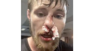 Uninsured Bryce Mitchell begs someone to set his broken nose for free